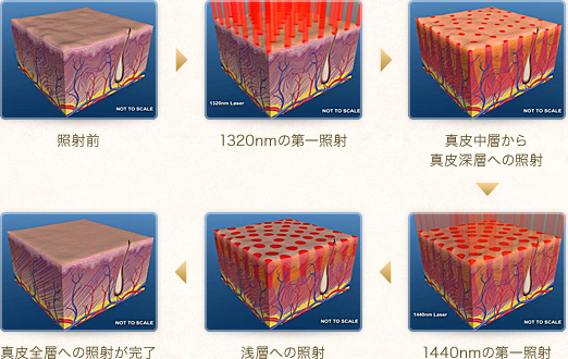 連続照射の様子を皮膚の組織図で解説