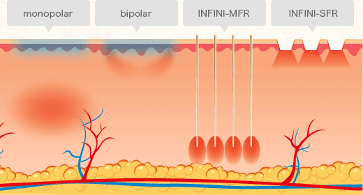 マイクロニードルRFレーザー