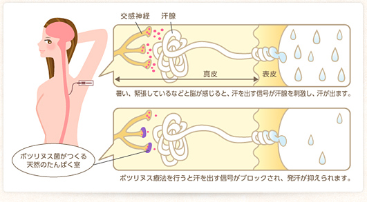 ボツリヌス療法が汗をおさえる仕組み